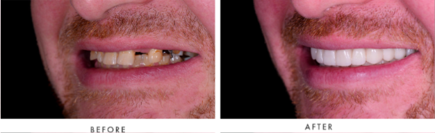 Dental Implants Transformation