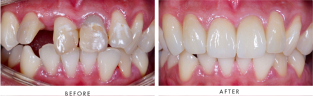 Dental Implants Transformation