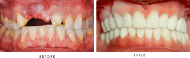 Full Mouth Dental Implants Transformation