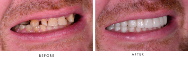 Porcelain Veneers Transformation