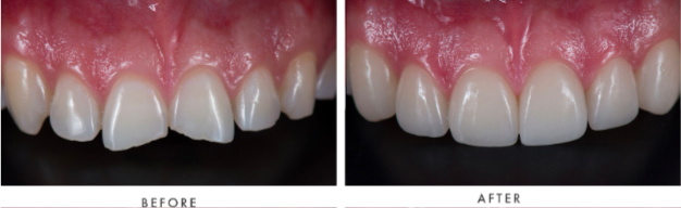 Teeth Whitening Transformation