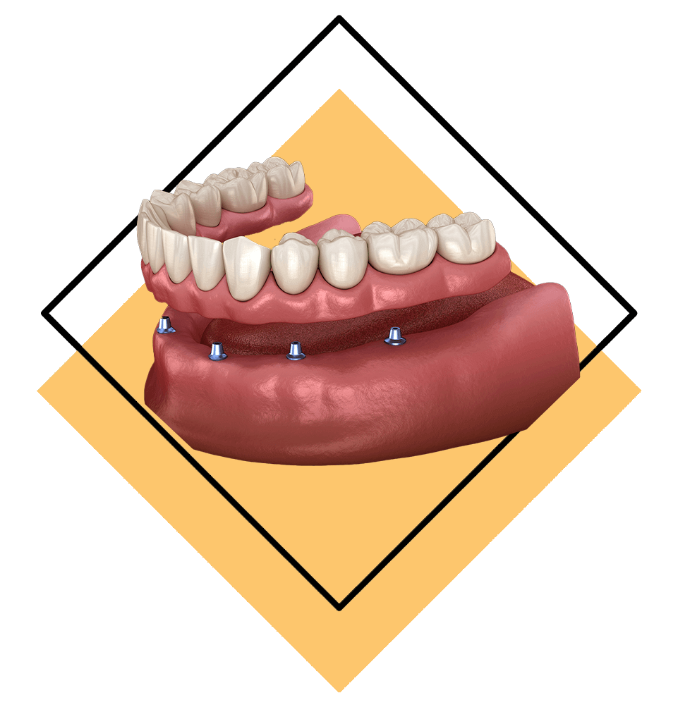 implant-supported-dentures